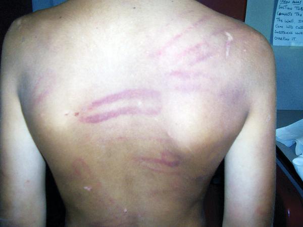 SOBER SIGNS: Brookfield Township Police took this picture of the marks and bruises on the body of an 8-year-old boy. His stepfather, Damion Wise, has been charged with felonious assault and child endangering.