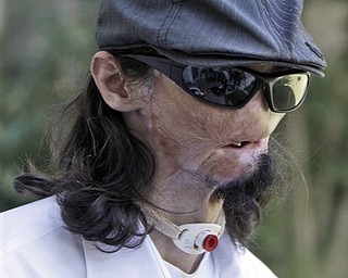In this Oct. 13, 2010 file photo, Dallas Wiens, 25, speaks during an interview in Fort Worth, Texas. Weins was critically burned in a 2008 high-voltage power line accident and received a full face transplant at Brigham and Women's Hospital in Boston, during the week of March 14, 2011.