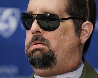 Face transplant recipient Dallas Wiens, of Fort Worth, Texas, takes questions from members of the media during a news conference at Brigham And Women's Hospital, in Boston, Monday, May 9, 2011. Wiens is the recipient of the first full face transplant in the United States.