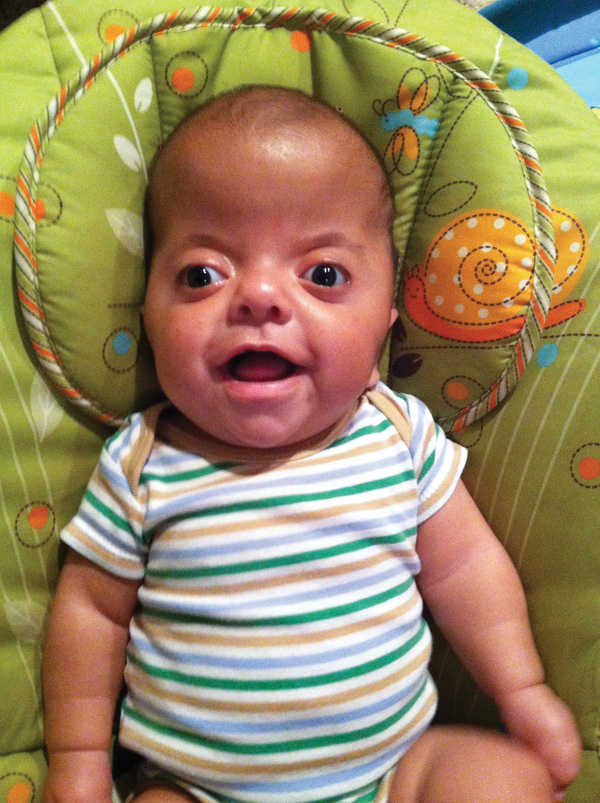 Jackson Diaz was born in June with Apert syndrome, a congenital disorder that affects the skull, face, feet
and hands. Only 20 children in the U.S. are born with Apert syndrome each year.