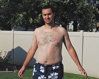David Buttar of Niles showing his scrapes with pride after trying to keep up with his son, Jacob.