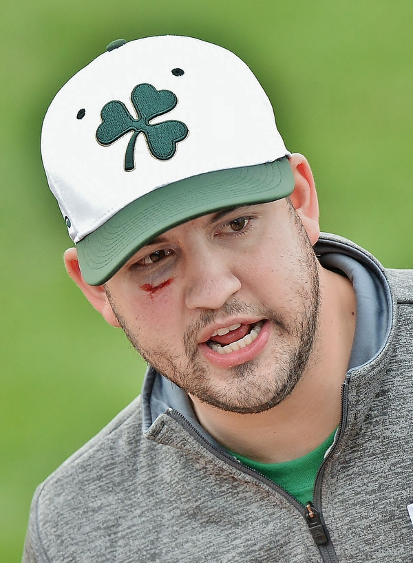 Jeff Lange | The Vindicator  WED, MAR 30, 2016 - Ursuline head coach Matt Weymer sports a shiner after being hit by a ball during pregame warmups at Bob Cene Park in Struthers Wednesday afternoon.