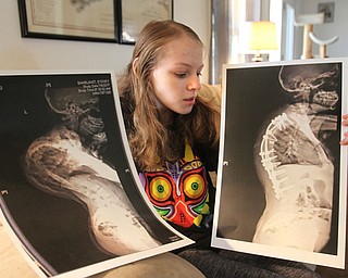 William D Lewis the vindicator Sydney Samplanet, 14, holds xrays of her spine before(left) and after surgery right The Sebring girls was diagnosed with Scoliosis when she was 6 months old and has had 17 surgeries.