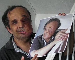 Ed Port After Surgery